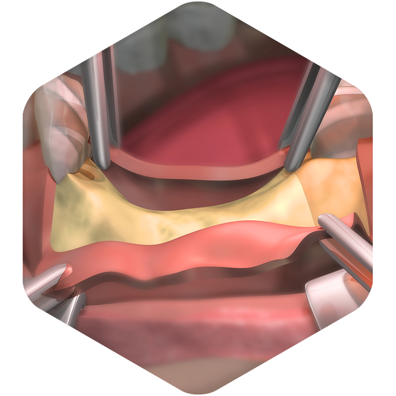 3D illustration of gums showing the underlying bone structure.
